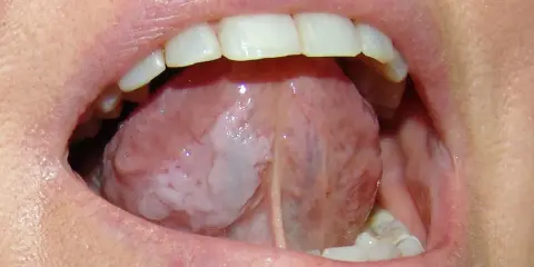 Lingua con aree biancastre, possibile leucoplachia, che potrebbe indicare un tumore alla lingua.