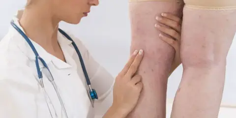 Lekarz bada nogi pacjentki, oceniając potencjalny stan zapalny i jego związek z d-dimerami.