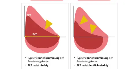 Diagramm zeigt Lungenfunktion bei Asthma. Links leichte Obstruktion mit PEF meist niedrig, rechts deutliche Obstruktion mit PEF deutlich niedrig.