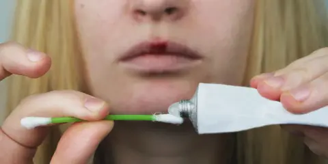 Person applicerar salva på ett sår på läppen, liknande hur man behandlar herpes i underlivet.