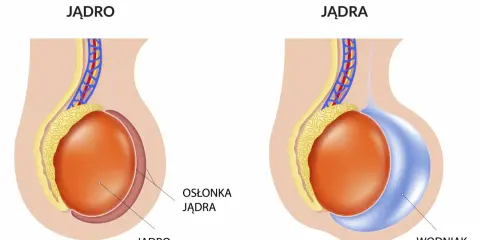 Porównanie prawidłowego jądra z wodniakiem jądra, który może pojawić się po operacji przepukliny pachwinowej.