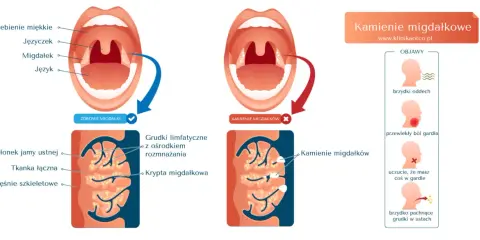 Ilustracja pokazuje, jak usunąć kamienie migdałkowe, porównując zdrowe migdałki z tymi z kamieniami, oraz objawy takie jak brzydki oddech.
