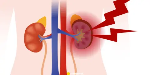 Ilustracja przedstawia nerkę z widocznym problemem, sugerującym poszerzoną miedniczkę nerkową u dziecka. Czerwone błyskawice symbolizują ból lub stan zapalny.