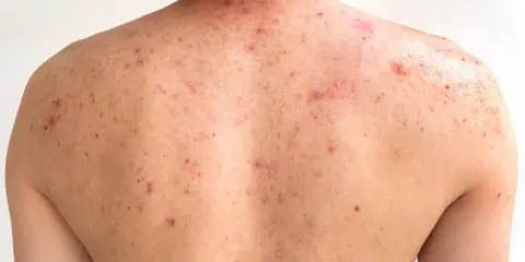 Le dos d'une personne présente de nombreuses imperfections rouges et enflammées, typiques de l'acné du dos.