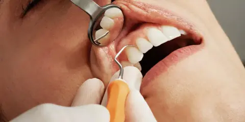 Dentysta wykonuje skaling zębów, używając narzędzi i lusterka.
