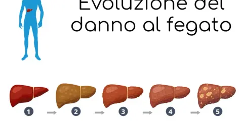 Evoluzione del danno epatico: da fegato sano a fegato grasso, poi fibrosi, cirrosi e infine tumore.