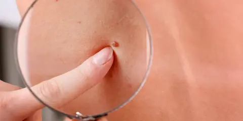 Un doigt pointe un grain de beauté rouge sous une loupe, examinant attentivement la peau.