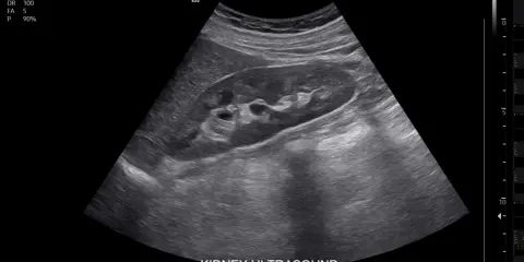 Obraz USG nerki. Czy usg jamy brzusznej wykryje raka? Badanie pokazuje strukturę nerki, pomagając w diagnostyce.