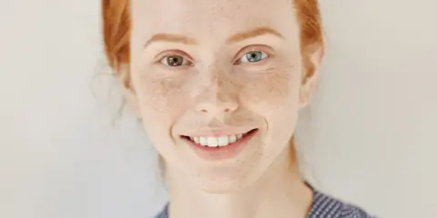 Ruda dziewczyna z piegami i różnymi kolorami oczu – przykład heterochromii.