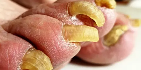 Dita con unghie gialle e ispessite, simili a quelle di un pappagallo, che crescono in modo anomalo.