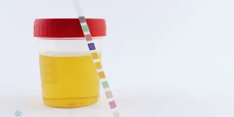 Pojemnik z żółtym płynem i paskiem testowym do analizy moczu. Kolory na pasku mogą wskazywać na różne parametry, w tym na ciemny mocz.