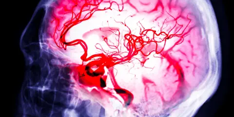 Immagine radiografica di un cervello con vasi sanguigni rossi evidenziati, che simboleggiano la lotta per l'aneurisma cerebrale sopravvivenza.