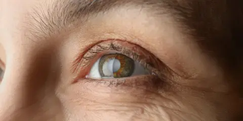 Gros plan sur un œil humain, montrant des rides autour de l'œil et une légère perte de cils.