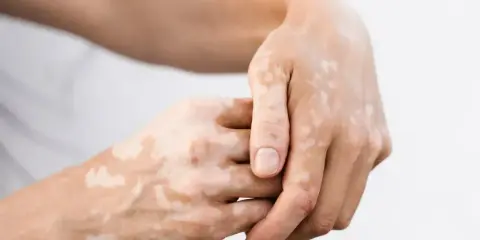 Dłonie z widocznymi, nieregularnymi plamami depigmentacji, charakterystycznymi dla bielactwa nabytego.