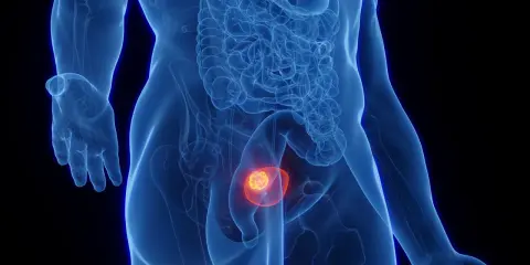 Anatomical rendering showing a glowing tumor within the bladder, indicative of a guz pęcherza moczowego icd 10.