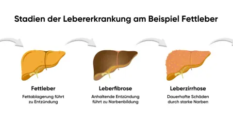 Illustration zeigt Stadien der Lebererkrankung: gesunde Leber, Fettleber, Leberfibrose, Leberzirrhose und Leberkrebs. Was tun bei Fettleber? Frühzeitige Behandlung ist wichtig.