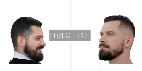 Przed i po: mężczyzna z brodą przed i po zabiegu konturowania brody.