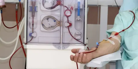 Dializator to urządzenie do prowadzenia terapii oczyszczającej krew. Pacjent podłączony do maszyny, widoczna jego ręka z kaniulą i czerwonymi przewodami.
