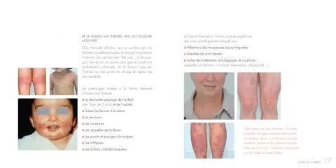 La Station thermale d'Avène traite diverses pathologies cutanées, comme l'eczéma et le psoriasis, illustrées par des photos.