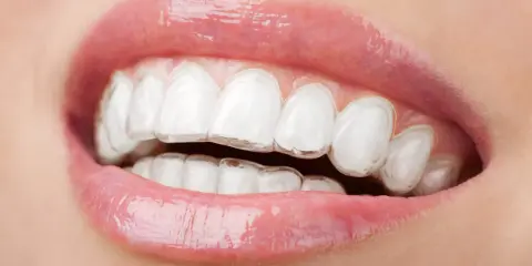 Zbliżenie na usta z widocznym aparatem Invisalign. Przezroczyste nakładki dyskretnie korygują zgryz, zapewniając piękny uśmiech.