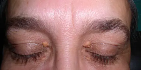 Żółtawe narośla na powiekach mogą być objawem wysokiego cholesterolu.