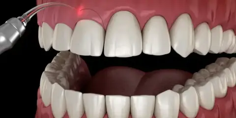 Zabieg gingiwektomii laserem: precyzyjne modelowanie dziąseł dla pięknego uśmiechu.