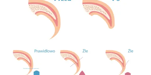 Ilustracja pokazuje przekrój pazura psa przed i po przycięciu. Pokazuje też prawidłowe i nieprawidłowe przycinanie, które może prowadzić do krwawienia.
