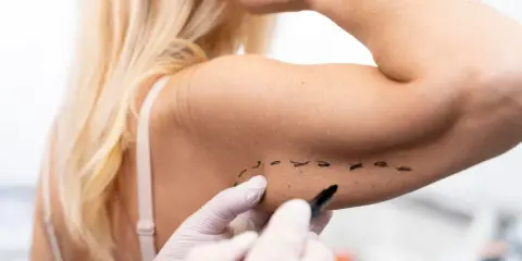 Medico disegna con pennarello su braccio, segnando una nuova tecnica per lifting braccia.