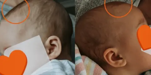 Dwa ujęcia główki niemowlaka, pokazujące jak zarasta ciemiączko. Widoczne są różnice w jego wielkości.