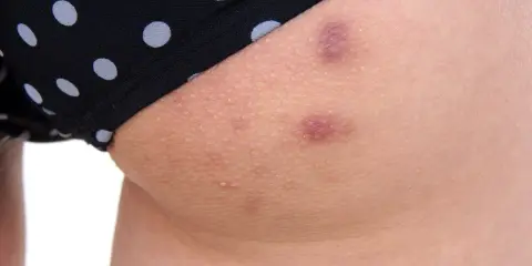 Krostki na pupie? Sprawdź, jak skutecznie odzyskać gładką skórę!