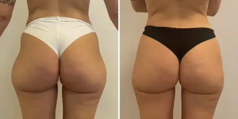 Lipofilling glutei prima e dopo: confronto visivo dei risultati. I glutei appaiono più voluminosi e armoniosi dopo il trattamento.