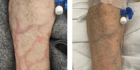 Braccio con segni di flebite, con vene rosse e gonfie in A, e un braccio più sano in B, con catetere venoso.