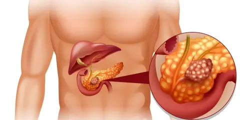 Ilustracja anatomiczna przedstawiająca trzustkę z guzem nowotworowym.