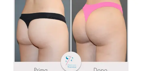 Risultati vaser lipo prima e dopo: glutei più voluminosi e scolpiti.