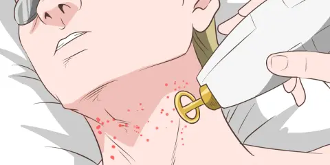 Persona con gafas protectoras recibe tratamiento láser para el acné en el cuello.