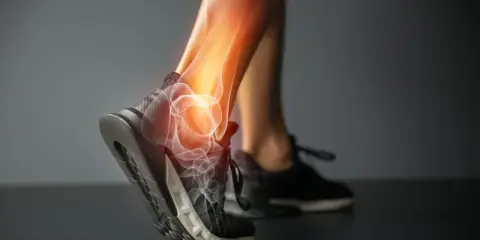 Anatomia skręconej kostki z widocznymi kośćmi i zapaleniem.