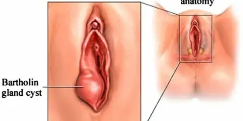 Ilustracja pokazuje zapalenie gruczołu Bartholina jako powiększoną torbiel po lewej stronie, w porównaniu do prawidłowej anatomii po prawej.