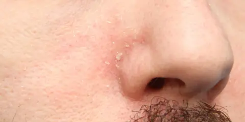 Pelle arrossata e desquamata intorno al naso, sintomo di dermatite seborroica.