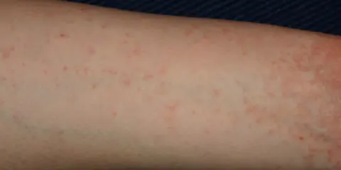 Braccio con piccoli puntini rossi, un segno di inizio scabbia. La pelle appare leggermente irritata.