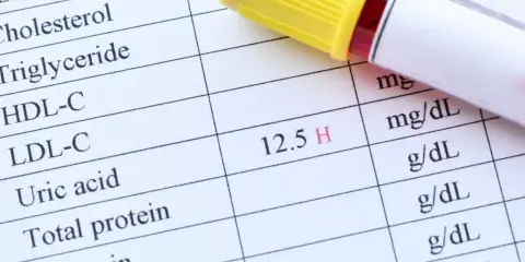 Wynik badania kwas moczowy: 12.5 H. To przekroczenie normy, co może wskazywać na problemy zdrowotne.