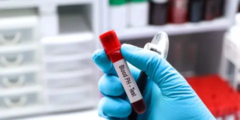 Ręka w niebieskiej rękawiczce trzyma probówkę z krwią do badania pH. Gazometria jest kluczowa w diagnostyce niewydolności nerek.