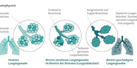 Veranschaulicht die Zerstörung von Lungenbläschen bei COPD, auch ohne Rauchen. Zeigt gesunde, erweiterte und geplatzte Lungenbläschen.