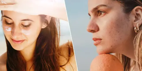 Visage protégé du soleil avec crème, puis profil avec acné et taches, une cicatrice soleil peut apparaître sans protection.