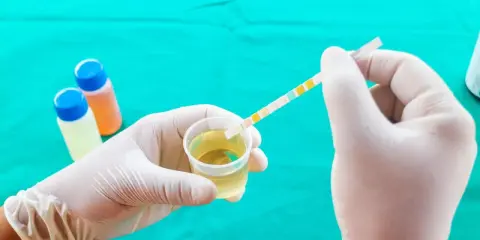 Rękawiczka medyczna zanurza pasek testowy w próbce moczu, szukając oznak cienkich nitek.