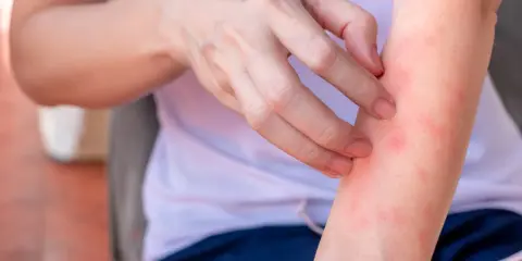 Dito, una persona si gratta il braccio, mostrando piccole macchie rosse che suggeriscono una sensazione di bruciore sulla pelle senza arrossamento visibile.