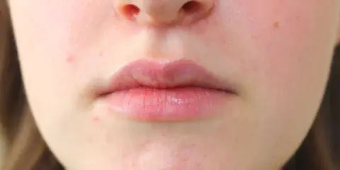 Primo piano del viso con labbra e naso. Si nota una leggera dermatite intorno al naso, con arrossamenti e piccole imperfezioni.