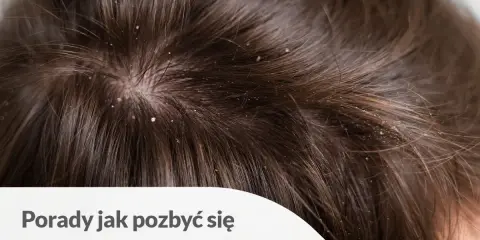 Widoczne białe płatki na ciemnych włosach i skórze głowy. Porady jak pozbyć się łupieżu ze skóry głowy.