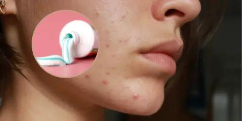 Czy pasta do zębów wysusza pryszcze? Dermatolog obala mit!