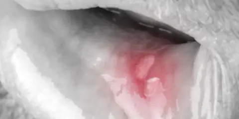 Afta i dentysta: Kiedy wizyta jest konieczna, a kiedy poczekać?