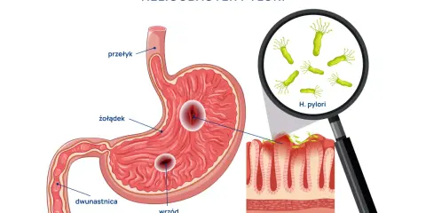 Ilustracja anatomiczna żołądka z wrzodami i bakteriami Helicobacter pylori pod lupą.